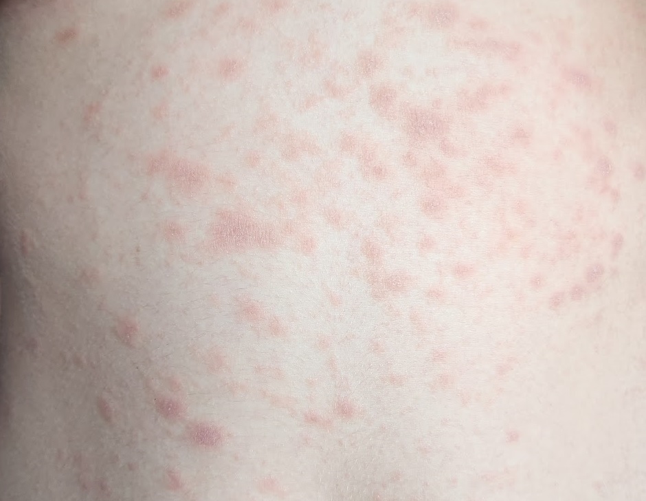 Rožinė dedervinė (lot. Pityriasis rosea) belly