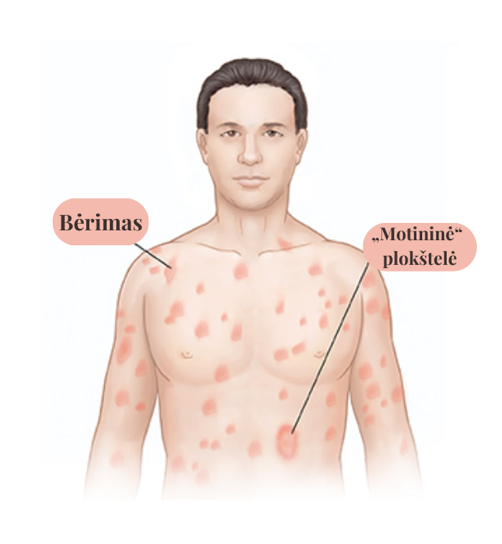 Rožinė dedervinė (lot. Pityriasis rosea) grafikas