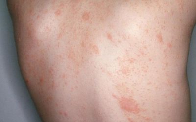 Pityriasis rosea