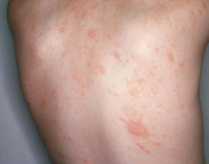 Rožinė dedervinė (lot. Pityriasis rosea).