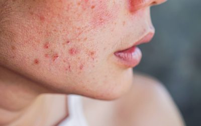 Menopauzės sukeltos odos būklės