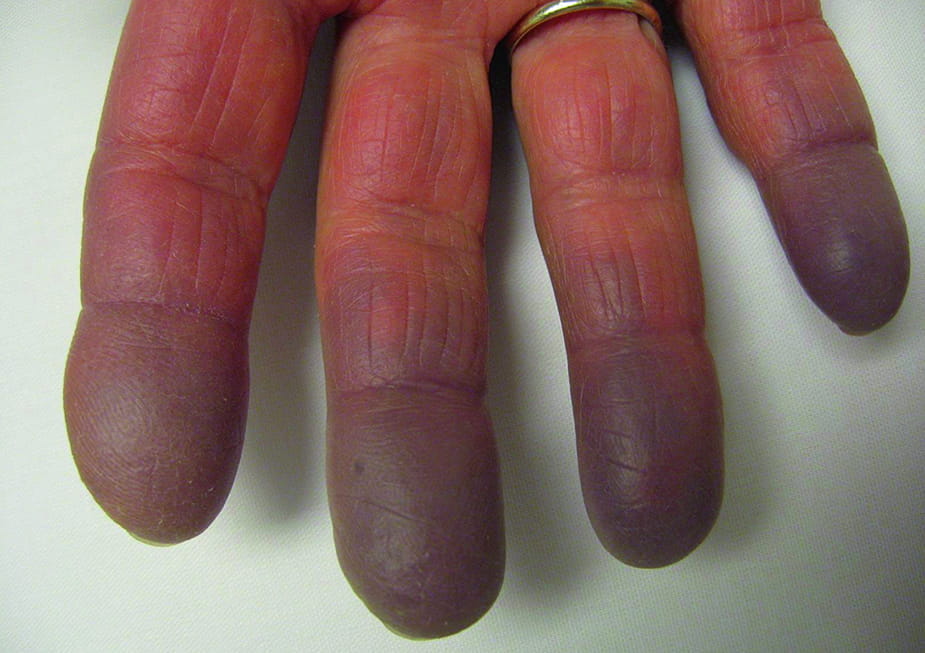 Akrocianozė - būdingas rankų ir kojų šalimas ir pamėlynavimas (cianozė)