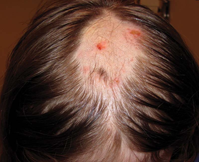Trichotilomanija (plaukų rovimasis) - nenumaldomas įprotis rautis plaukus, sukeliantis nuplikimą