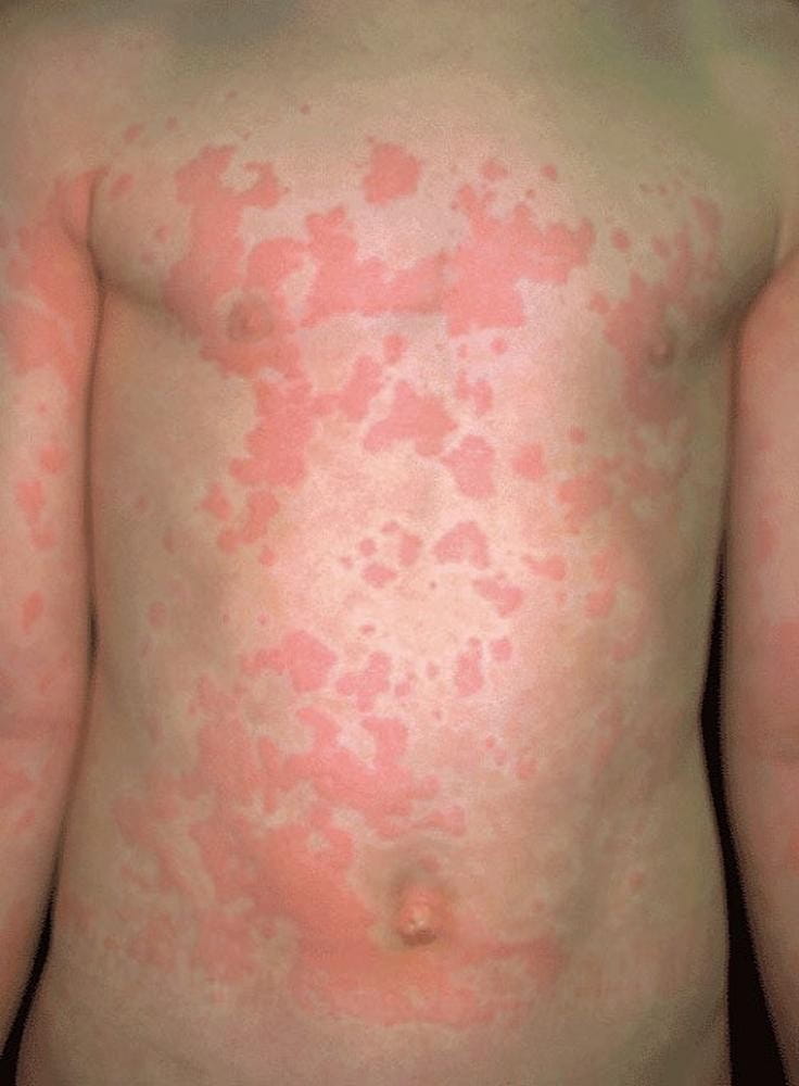 alerginį, dilgėlinės pobūdžio, niežtintį bėrimą ar būgno lazdelių formos pirštų atsiradimą