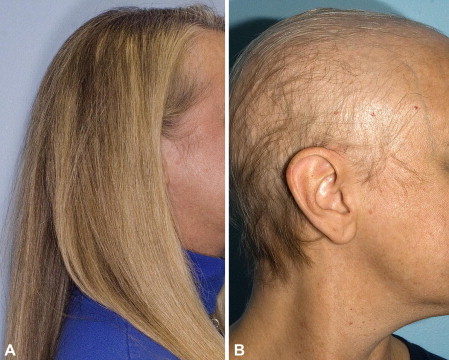 Plaukų slinkimas (Alopecija) Chemoterapinių vaistų šalutinis poveikis odai