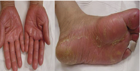 Rankų-pėdų sindromas Chemoterapinių vaistų šalutinis poveikis odai