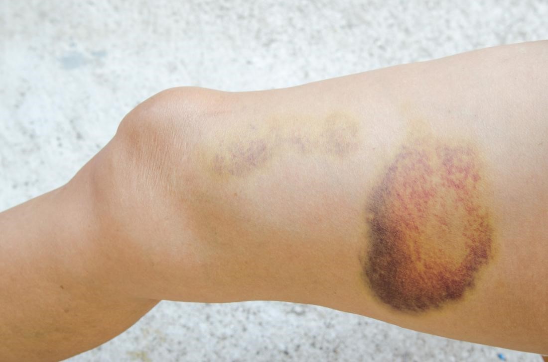 Hematoma: Simptomai, Gydymas ir Diagnostika