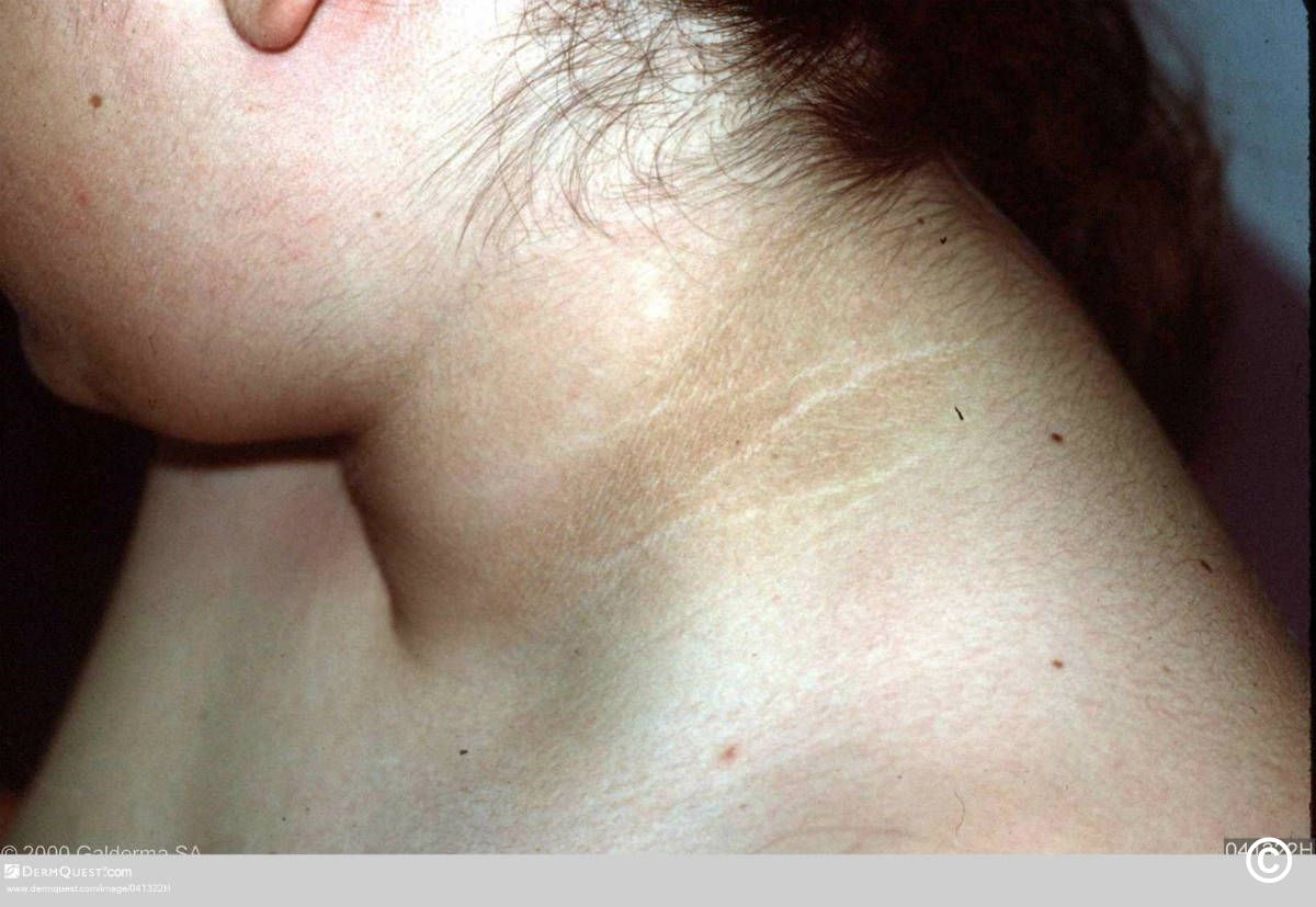 Acanthosis nigricans: pigmentacija ant sprando