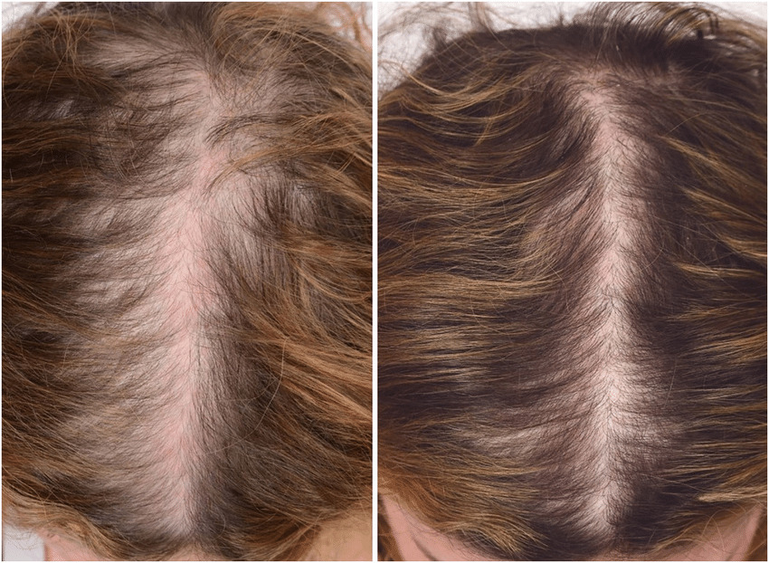 Androgeninė alopecija dėl PKS