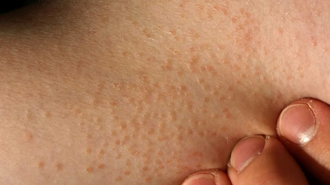 Dermatologo konsultacija dėl blizgančios kerpligės gydymo