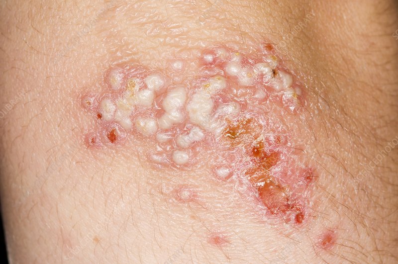 Dermatologo konsultacija dėl pasikartojančio Herpes simplex gydymo