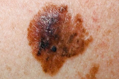 Melanoma: Piktybinio Apgamo Diagnostika Ir Gydymas 