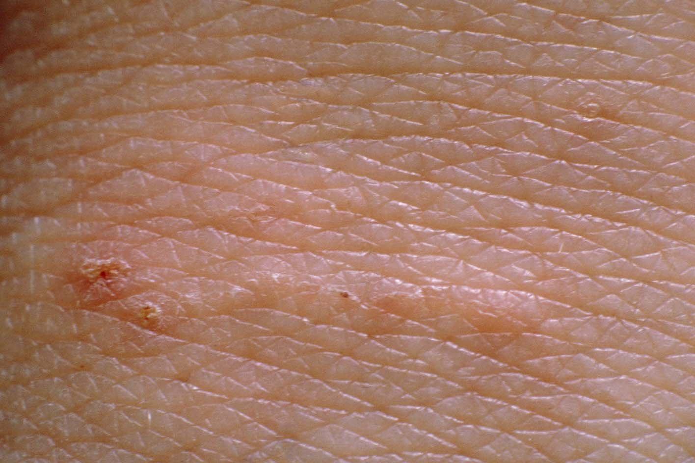 Dermatoskopija diagnozuojant niežus