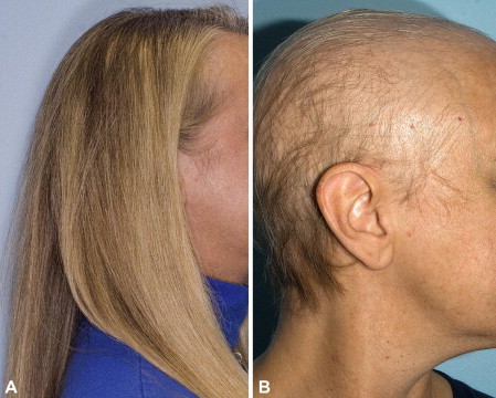 Alopecija po chemoterapijos: plaukų slinkimas ir odos priežiūra