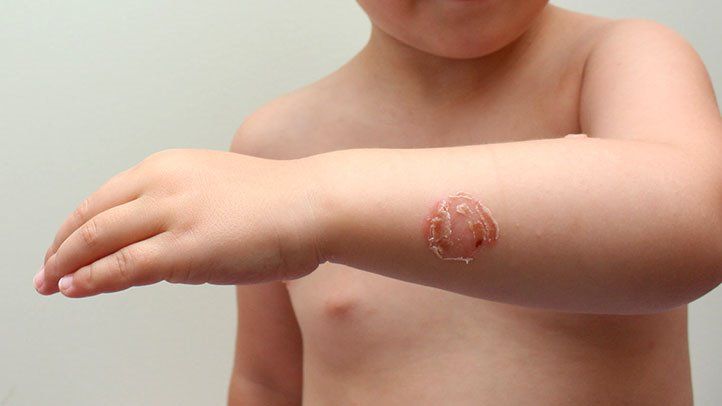 Pūslinė impetiga: skysčio pripildytos pūslės ant rankų odos