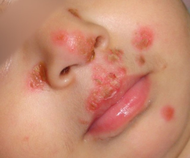 Impetiga: geltoni šašai aplink nosį ir burną