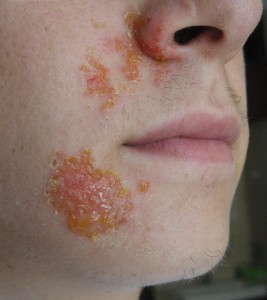 Dermatologo konsultacija dėl užkrečiamosios impetigos gydymo