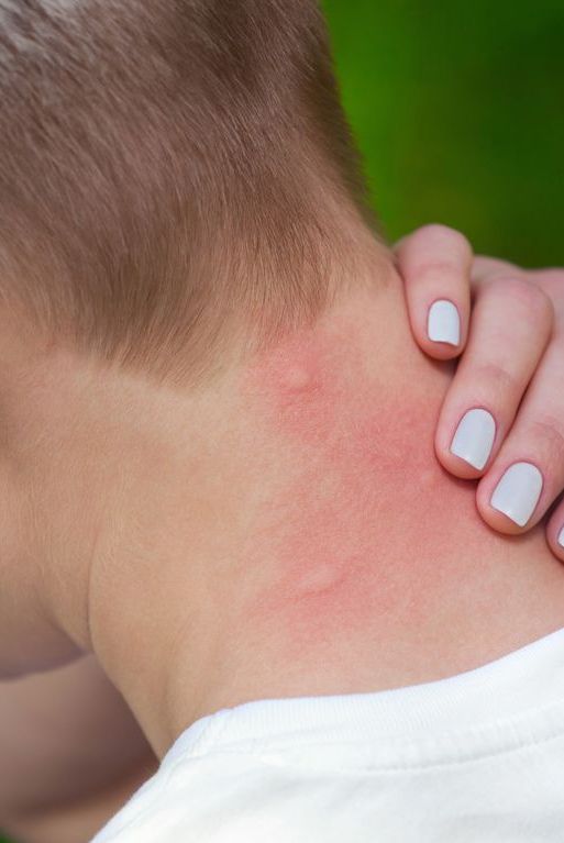 Blakių įkandimai: linijinis bėrimas ant kaklo ir rankų