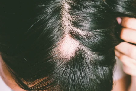 Dermatoskopija diagnozuojant židininę alopeciją