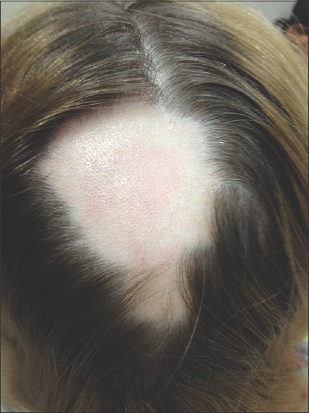 Dermatoskopija diagnozuojant židininę alopeciją