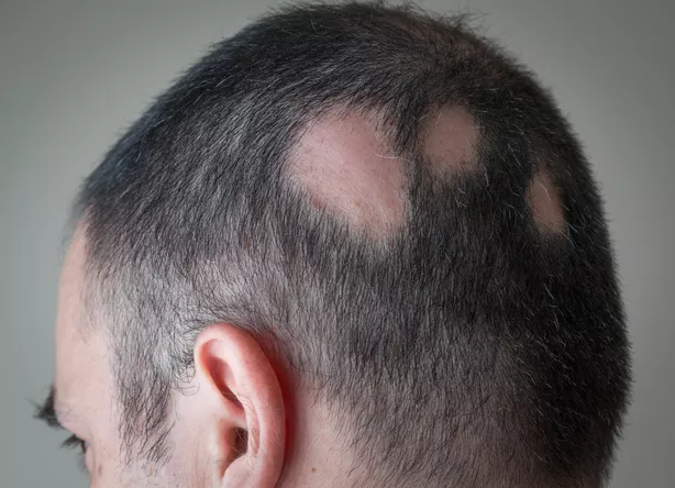 Židininė alopecija: apvalios plikimo dėmės ant galvos odos