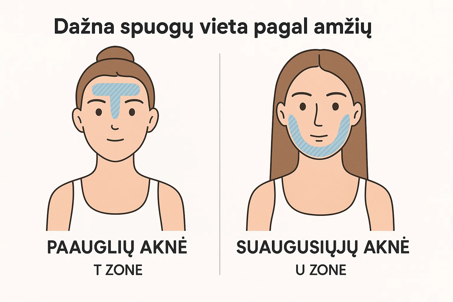 Spuogų vieta pagal amžių Spuogų vieta pagal amžių