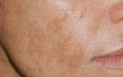 Hyperpigmentation: Causes, Types, and Modern Treatment Options