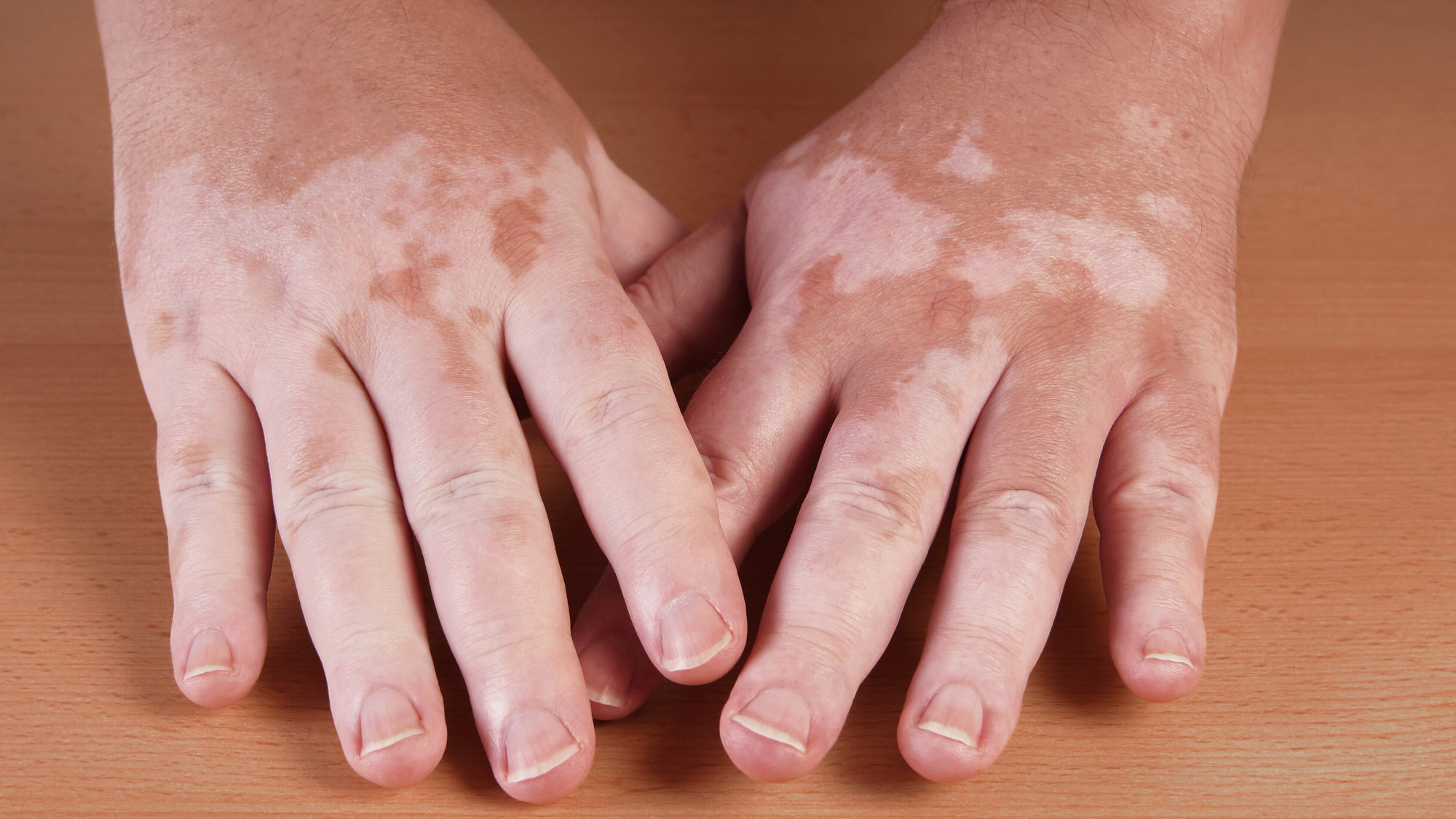 Vitiligo on hands **Generalized vitiligo on both arms – symmetrically distributed white patches on the skin**