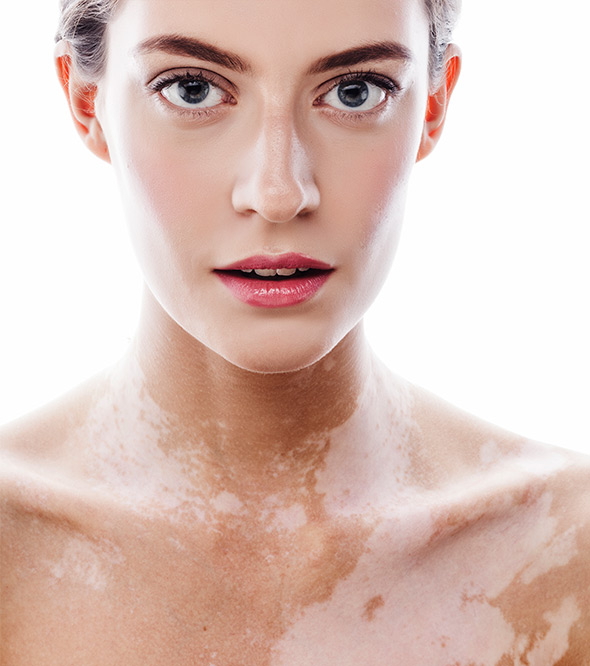 vitiligo **Psychological support for people with vitiligo – emotional assistance and counseling**